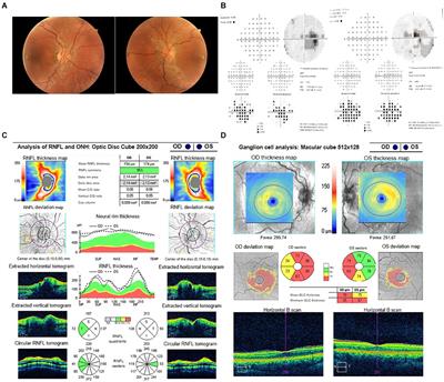 Recognizing Leber’s Hereditary Optic Neuropathy to avoid delayed diagnosis and misdiagnosis